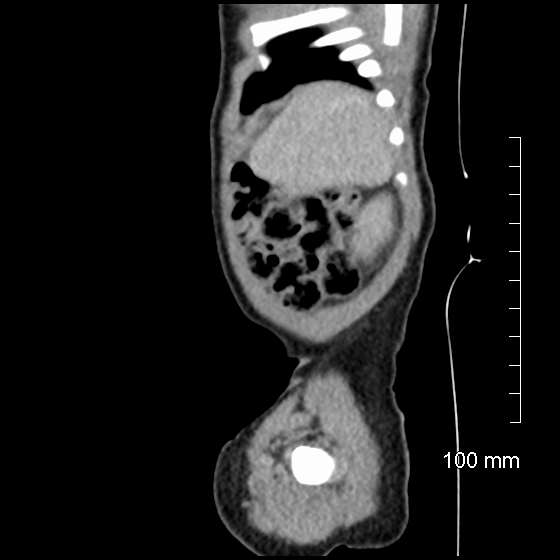 File:Neonatal neuroblastoma (Radiopaedia 56651-63438 C 19).jpg
