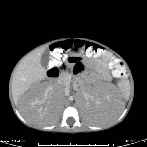 File:Nephroblastomatosis (Radiopaedia 41934-44935 A 18).jpg