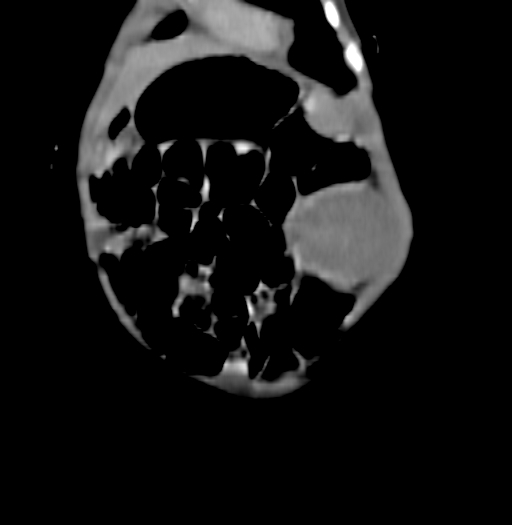 Nephroblastomatosis (Radiopaedia 71294-81607 B 61).jpg