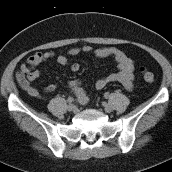 File:Nephrostomy for urosepsis (Radiopaedia 26180-26330 Axial non-contrast 45).jpg