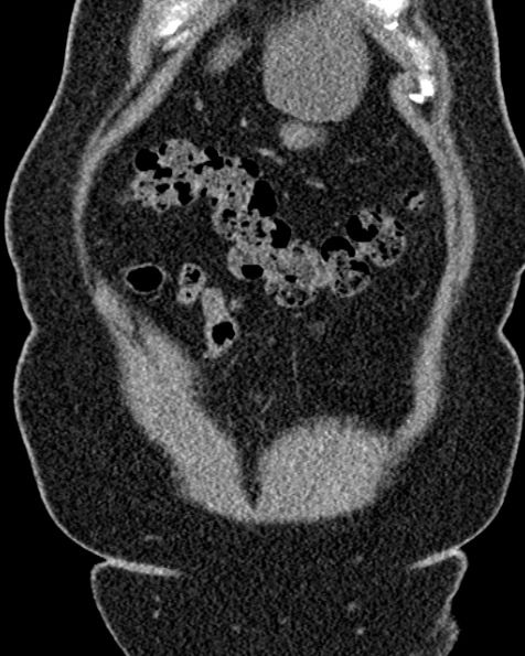 File:Nephrostomy for urosepsis (Radiopaedia 26180-26330 non-contrast 16).jpg