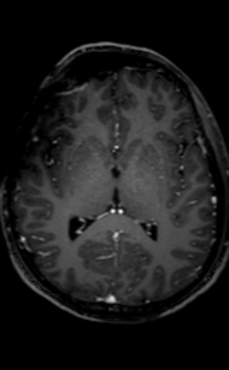 Neuro-Behçet disease (Radiopaedia 90112-107294 Axial T1 C+ 128).jpg