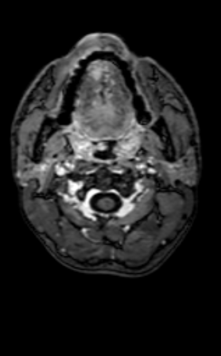 Neuro-Behçet disease (Radiopaedia 90112-107294 Axial T1 C+ 224).jpg