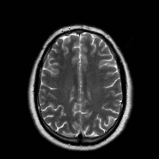 File:Neuro-Behcet's disease (Radiopaedia 21557-21505 Axial T2 16).jpg