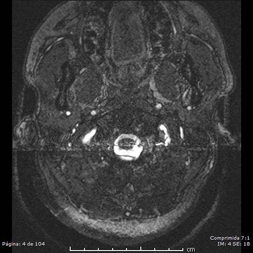 Neurocysticercosis (Radiopaedia 58636-65832 I 4).jpg