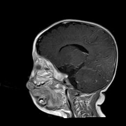 File:Neurofibromatosis type 1 (Radiopaedia 30089-30671 Sagittal T1 C+ 12).jpg