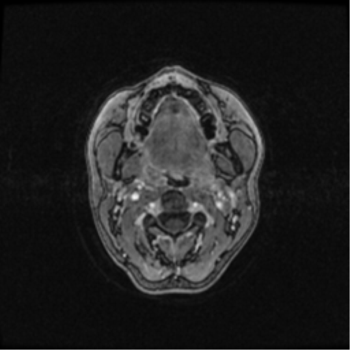 Neurofibromatosis type 2 (Radiopaedia 45229-49244 Axial T1 C+ 4).png