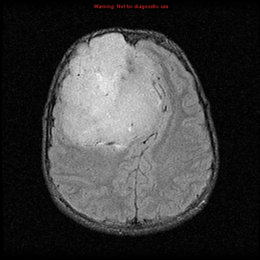 File:Neurofibromatosis type 2 (Radiopaedia 8953-9730 Axial FLAIR 19).jpg