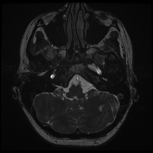 File:Neurofibromatosis type 2 - bilateral acoustic neuromata (Radiopaedia 40060-42566 Axial FIESTA 21).png