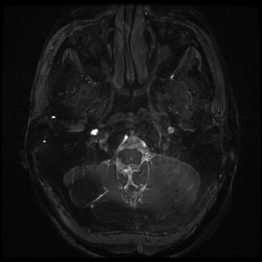 Neurofibromatosis type 2 - bilateral acoustic neuromata (Radiopaedia 40060-42566 Axial FIESTA 5).png