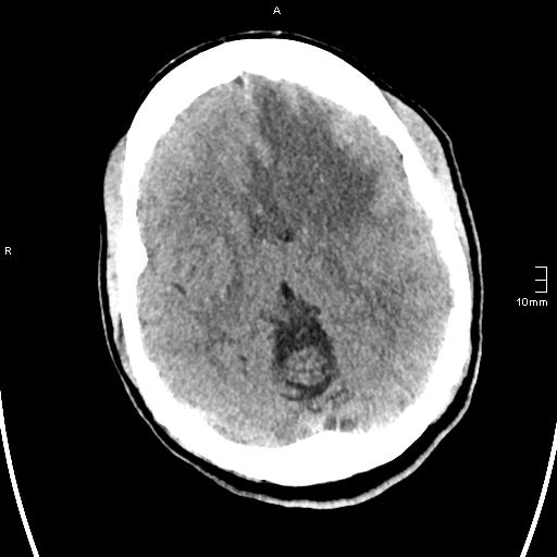 File:Neurotoxoplasmosis - concentric target sign (Radiopaedia 70644-80783 Axial non-contrast 18).jpg