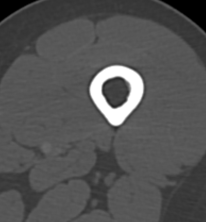 Non-ossifying fibroma - femur (Radiopaedia 82786-97042 Axial bone window 12).jpg