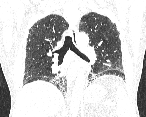 Non-specific interstitial pneumonia (NSIP) (Radiopaedia 68599-78228 Coronal lung window 57).jpg