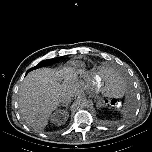 File:Non Hodgkin lymphoma in a patient with ankylosing spondylitis (Radiopaedia 84323-99621 Axial non-contrast 27).jpg
