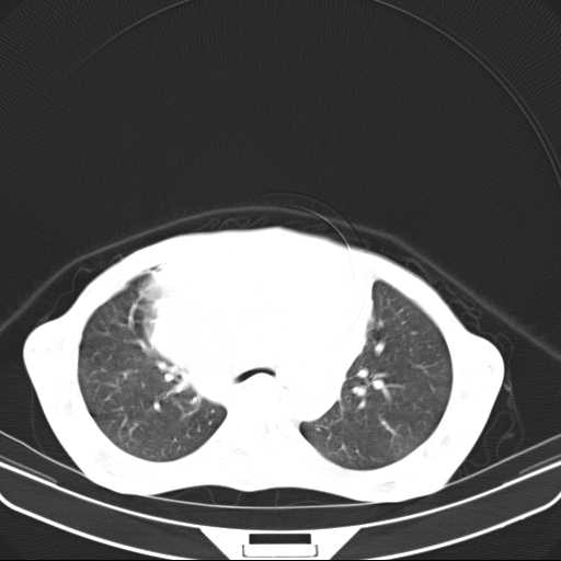 File:Non hodgkin lymphoma of the mediastinum (Radiopaedia 20814-20729 Axial lung window 19).jpg