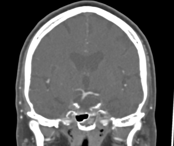 File:Normal CTA head (Radiopaedia 40801-43464 B 49).png