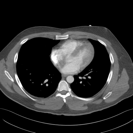 File:Normal CTA thorax (non ECG gated) (Radiopaedia 41750-44704 A 60).png