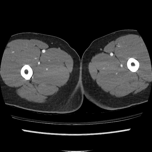 File:Normal CT angiogram of pelvis (Radiopaedia 45390-49430 A 73).jpg