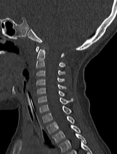Normal CT cervical spine - pediatric (Radiopaedia 52549-58462 Sagittal bone window 115).jpg