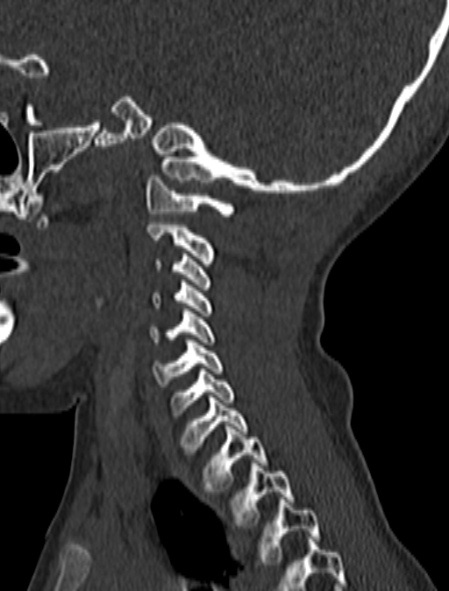 Normal CT cervical spine - pediatric (Radiopaedia 52549-58462 Sagittal bone window 46).jpg