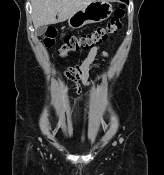 Normal CT intravenous urogram (Radiopaedia 39444-41759 A 198).jpg