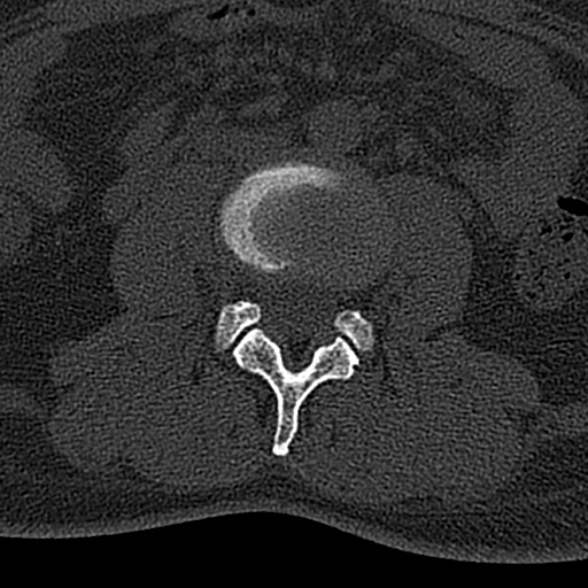 File:Normal CT lumbar spine (Radiopaedia 53981-60118 Axial bone window 41).jpg