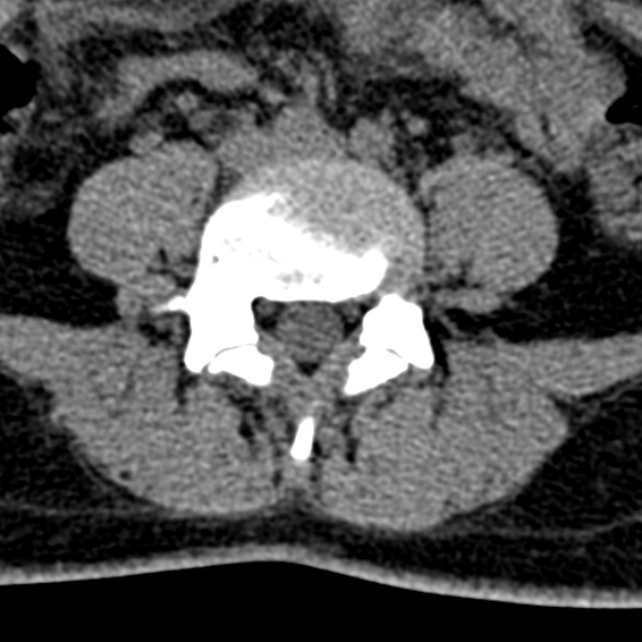 Normal CT lumbar spine (Radiopaedia 53981-60118 Axial non-contrast 73).jpg
