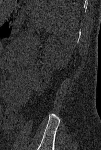 File:Normal CT lumbar spine (Radiopaedia 53981-60118 Sagittal bone window 102).jpg