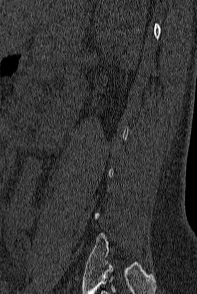 File:Normal CT lumbar spine (Radiopaedia 53981-60118 Sagittal bone window 83).jpg