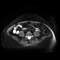 Normal MRI abdomen in pregnancy (Radiopaedia 88005-104548 Axial DWI 32).jpg