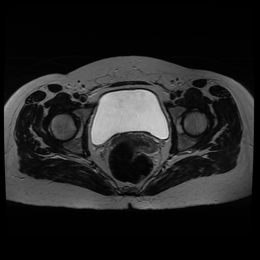 Normal MRI abdomen in pregnancy (Radiopaedia 88005-104548 Axial T2 38).jpg