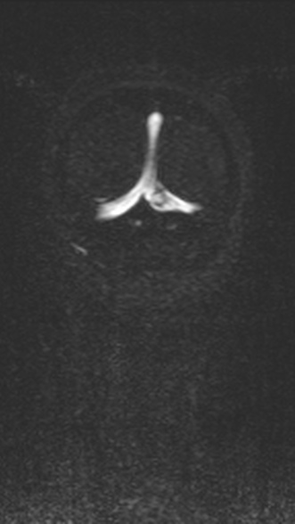 Normal MRI brain with MRV- teenager (Radiopaedia 49425-54553 Coronal MRV 213).jpg