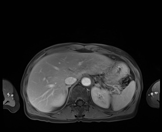 Normal adrenal glands MRI (Radiopaedia 82017-96004 M 21).jpg