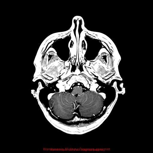 Normal adult brain MRI (non-enhanced and contrast-enhanced) (Radiopaedia 75262-86379 Axial T1 C+ 55).jpg