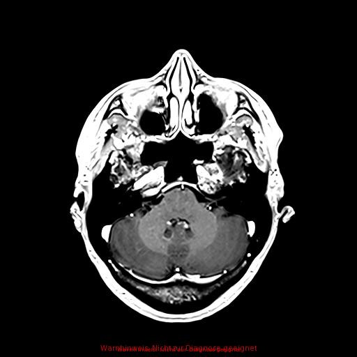 Normal adult brain MRI (non-enhanced and contrast-enhanced) (Radiopaedia 75262-86379 Axial T1 C+ 68).jpg