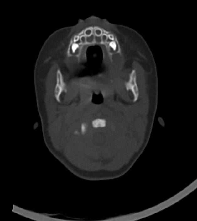 Normal brain CT - 2-month-old (Radiopaedia 53369-59350 Axial bone window 59).jpg