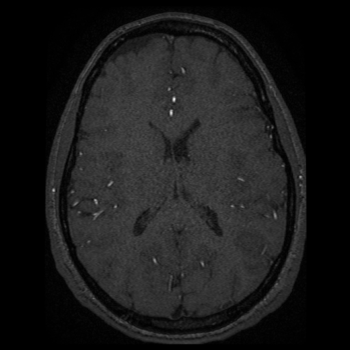 Normal brain MRA (Radiopaedia 41046-43793 Axial MRA 5).png