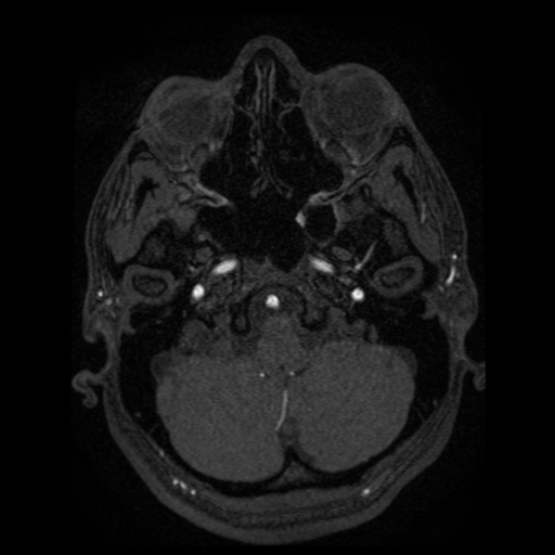 Normal brain MRA (Radiopaedia 41046-43793 Axial MRA 99).png