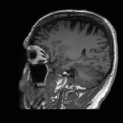Normal brain MRI (non-focal epilepsy protocol) (Radiopaedia 53917-60040 Sagittal T1 20).png