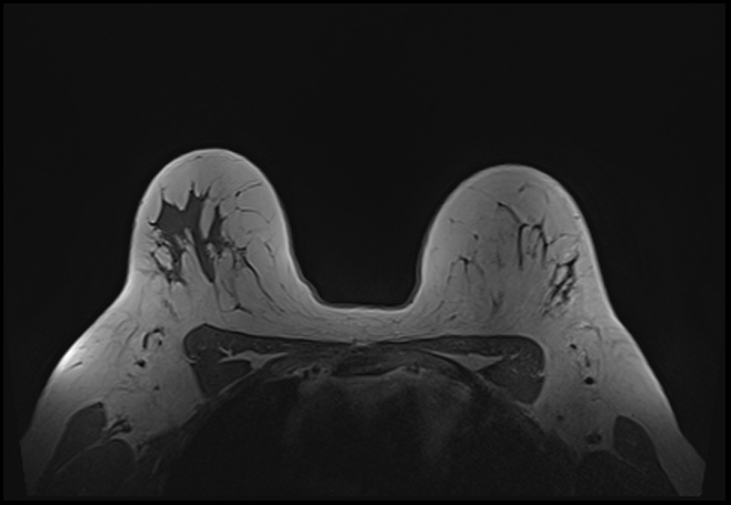 File:Normal breast MRI - dense breasts (Radiopaedia 80454-93850 Axial T1 163).jpg