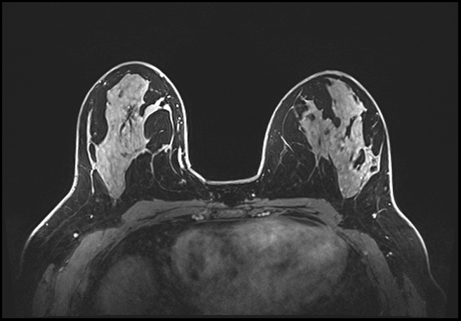 Normal breast MRI - dense breasts (Radiopaedia 80454-93850 C 111).jpg