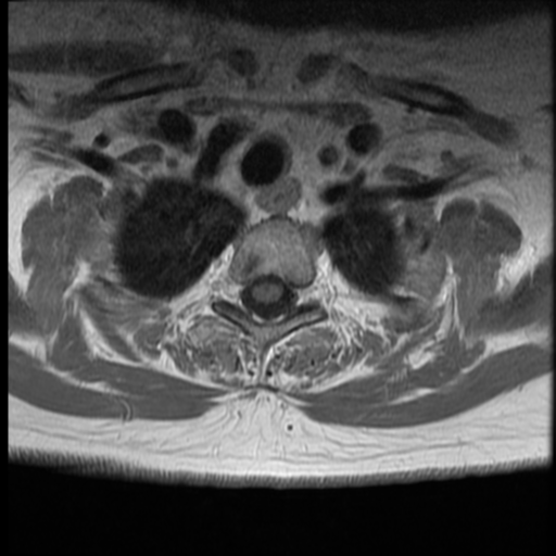 File:Normal cervical and thoracic spine MRI (Radiopaedia 35630-37156 Axial T1 C+ 4).png