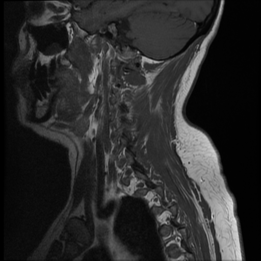 File:Normal cervical and thoracic spine MRI (Radiopaedia 35630-37156 Sagittal T1 12).png