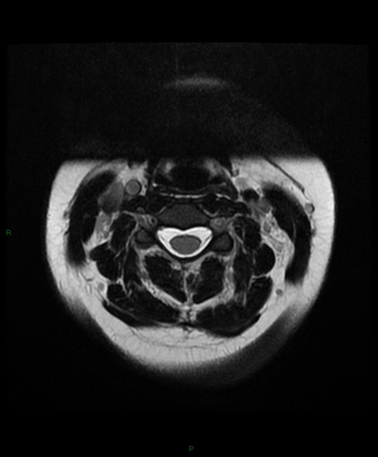 Normal cervical spine MRI (Radiopaedia 80146-93454 Axial T2 31).jpg