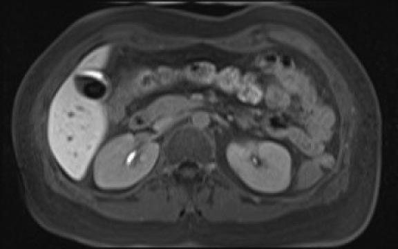 File:Normal hepatobiliary phase liver MRI (Radiopaedia 58968-66230 A 56).jpg