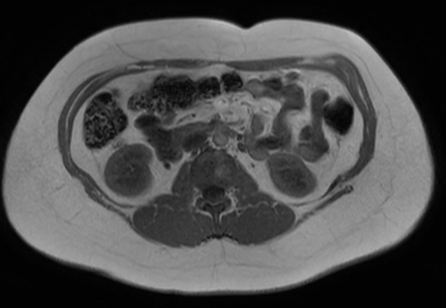 File:Normal liver MRI with Gadolinium (Radiopaedia 58913-66163 Axial T1 in-phase 9).jpg