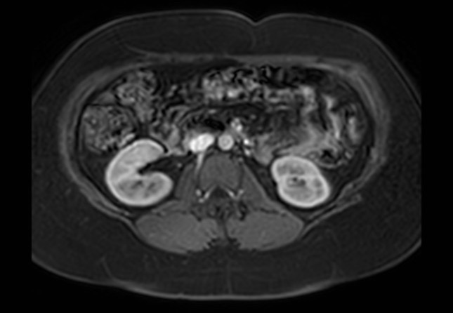 Normal liver MRI with Gadolinium (Radiopaedia 58913-66163 J 14).jpg