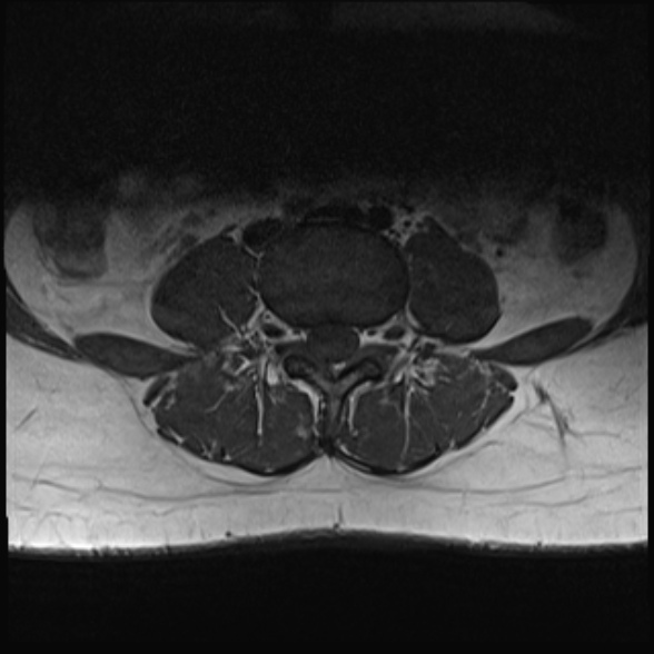 File:Normal lumbar spine MRI- 3 T (Radiopaedia 53280-59250 Axial 17).jpg