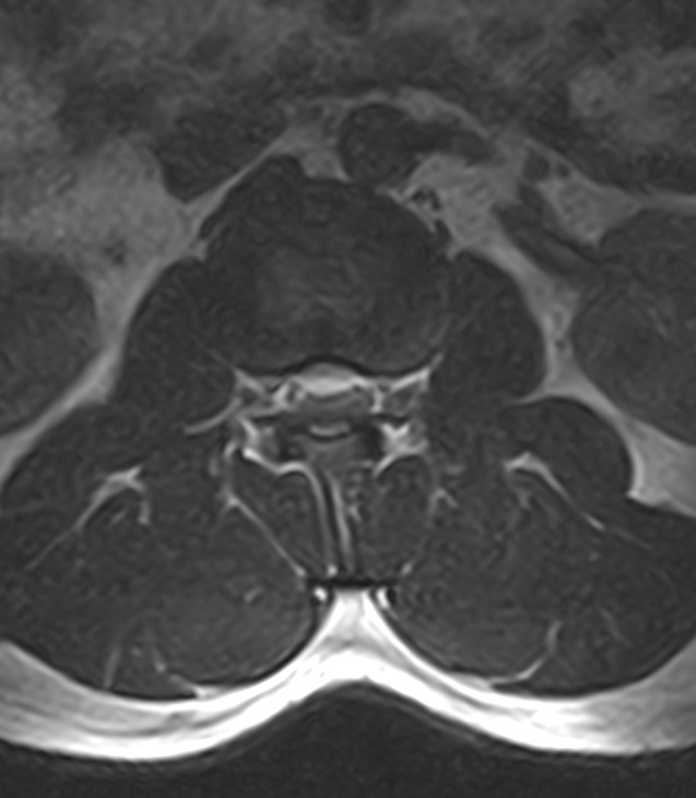 Normal lumbar spine MRI - low-field MRI scanner (Radiopaedia 40976-43699 Axial T2 30).jpg