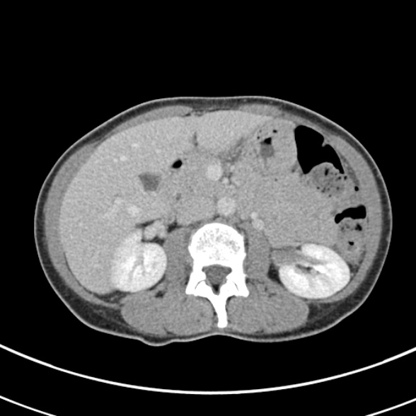 File:Normal multiphase CT liver (Radiopaedia 38026-39996 C 34).jpg